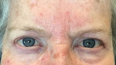 Blepharoplasty Before & After Gallery - Patient 716725 - Image 2