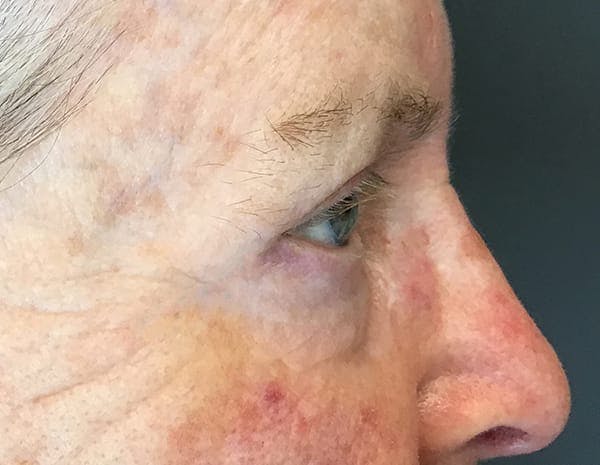 Blepharoplasty Before & After Gallery - Patient 716725 - Image 4