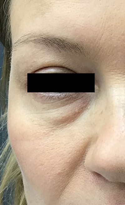 Blepharoplasty Before & After Gallery - Patient 399335 - Image 1