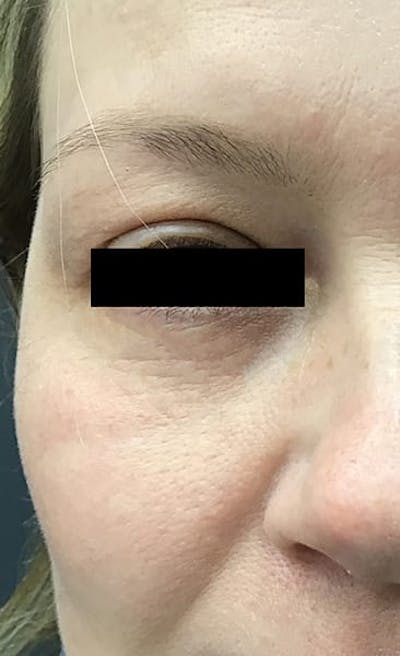 Blepharoplasty Before & After Gallery - Patient 399335 - Image 2