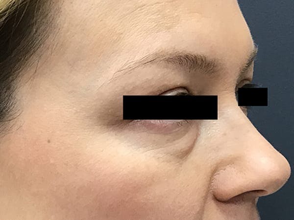 Blepharoplasty Before & After Gallery - Patient 399335 - Image 3