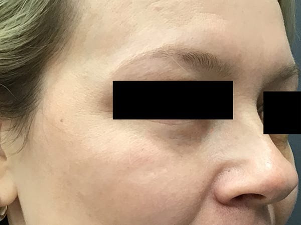 Blepharoplasty Before & After Gallery - Patient 399335 - Image 4