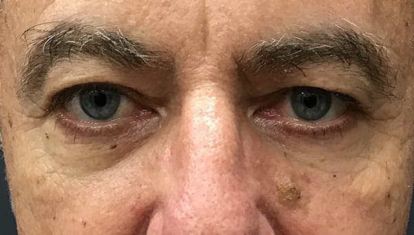 Blepharoplasty Before & After Gallery - Patient 278493 - Image 1