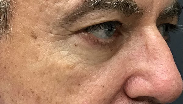 Blepharoplasty Before & After Gallery - Patient 278493 - Image 5