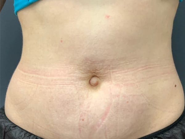 Body Contouring Before & After Gallery - Patient 101066 - Image 1