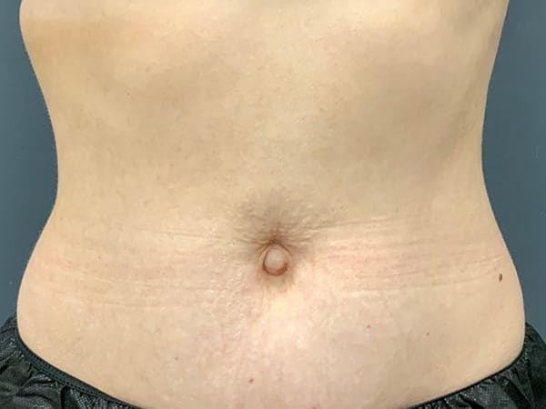 Body Contouring Before & After Gallery - Patient 101066 - Image 2