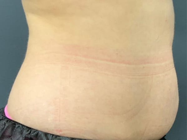 Body Contouring Before & After Gallery - Patient 101066 - Image 3