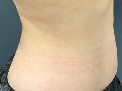 Body Contouring Before & After Gallery - Patient 101066 - Image 4