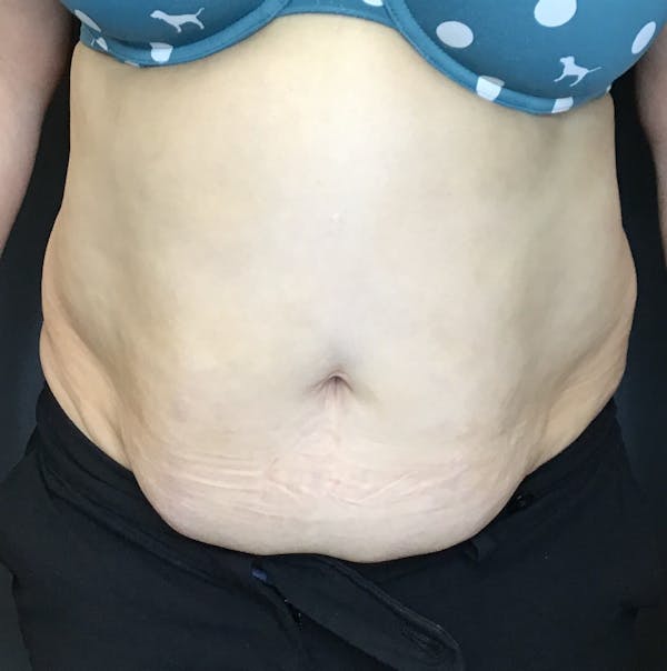 Body Contouring Before & After Gallery - Patient 421147 - Image 2