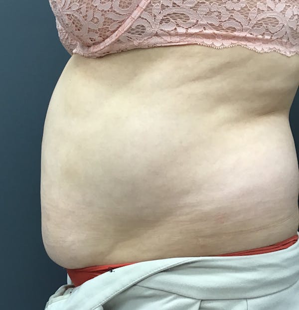 Body Contouring Before & After Gallery - Patient 421147 - Image 3