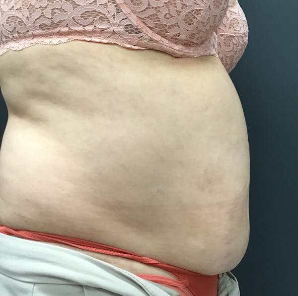 Body Contouring Before & After Gallery - Patient 421147 - Image 5
