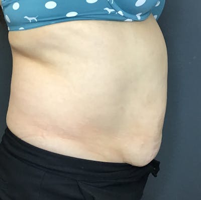 Body Contouring Before & After Gallery - Patient 421147 - Image 6