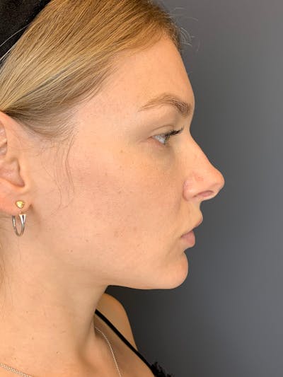Body Contouring Before & After Gallery - Patient 297506 - Image 2