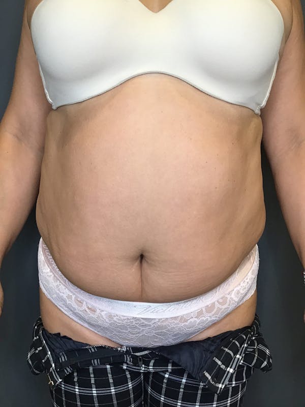 Body Contouring Before & After Gallery - Patient 344197 - Image 1