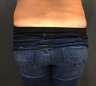Body Contouring Before & After Gallery - Patient 312855 - Image 2
