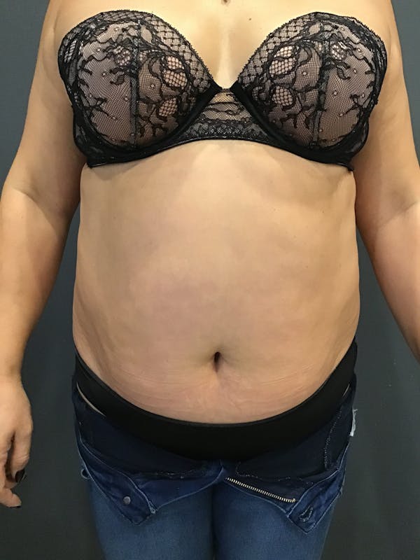 Body Contouring Before & After Gallery - Patient 312855 - Image 4