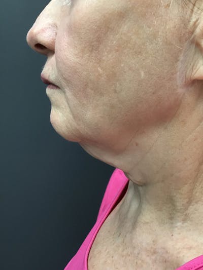 Body Contouring Before & After Gallery - Patient 731356 - Image 1
