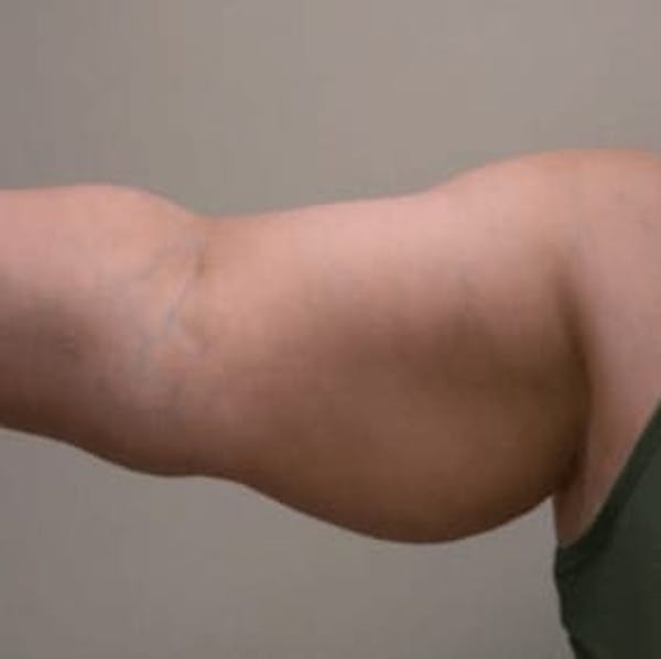Body Contouring Before & After Gallery - Patient 127788 - Image 1