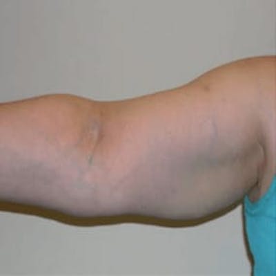 Body Contouring Before & After Gallery - Patient 127788 - Image 2