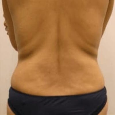 Body Contouring Before & After Gallery - Patient 407672 - Image 1