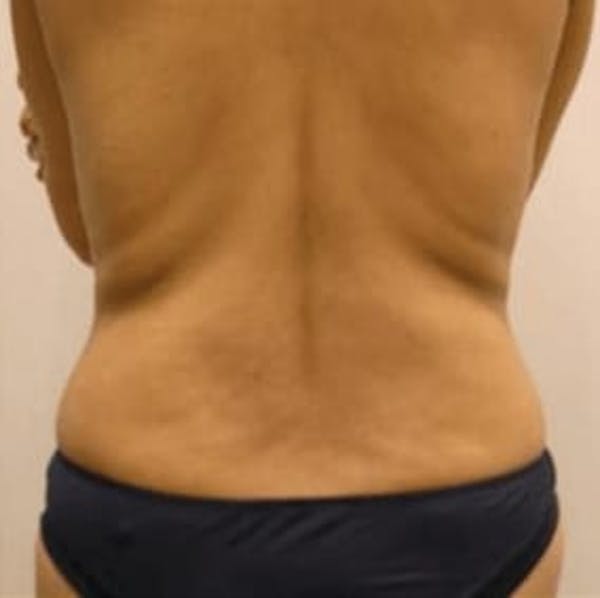 Body Contouring Before & After Gallery - Patient 407672 - Image 1