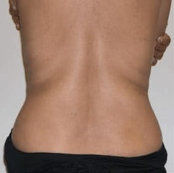 Body Contouring Before & After Gallery - Patient 407672 - Image 2