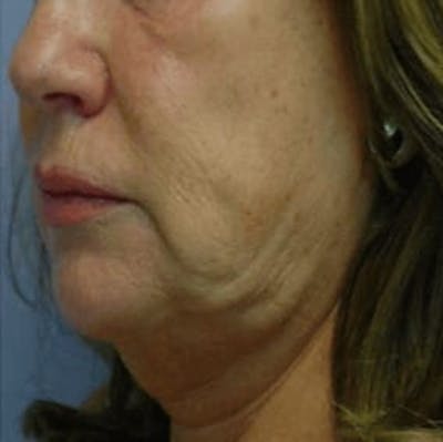 Body Contouring Before & After Gallery - Patient 113412 - Image 1