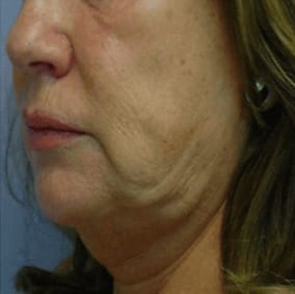 Body Contouring Before & After Gallery - Patient 113412 - Image 1