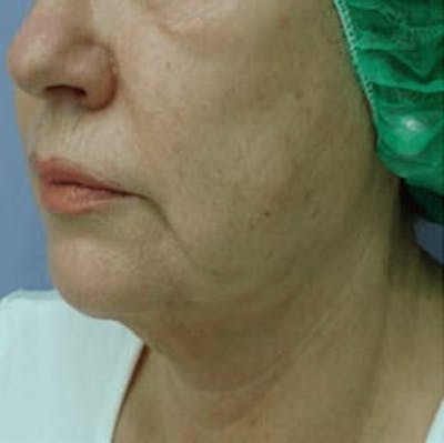 Body Contouring Before & After Gallery - Patient 113412 - Image 2