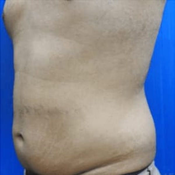 Body Contouring Before & After Gallery - Patient 395315 - Image 1