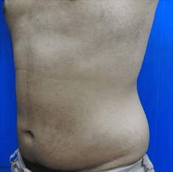 Body Contouring Before & After Gallery - Patient 395315 - Image 2