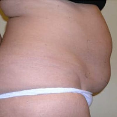 Body Contouring Before & After Gallery - Patient 245372 - Image 1
