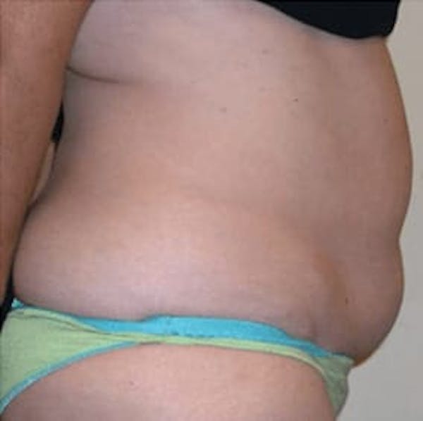 Body Contouring Before & After Gallery - Patient 245372 - Image 2