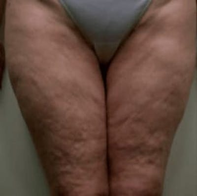 Body Contouring Before & After Gallery - Patient 144703 - Image 1