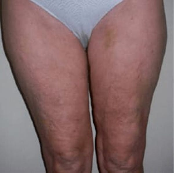 Body Contouring Before & After Gallery - Patient 144703 - Image 2