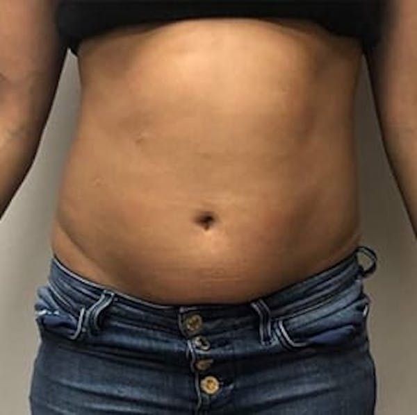 Body Contouring Before & After Gallery - Patient 158177 - Image 1