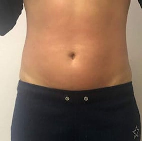 Body Contouring Before & After Gallery - Patient 158177 - Image 2