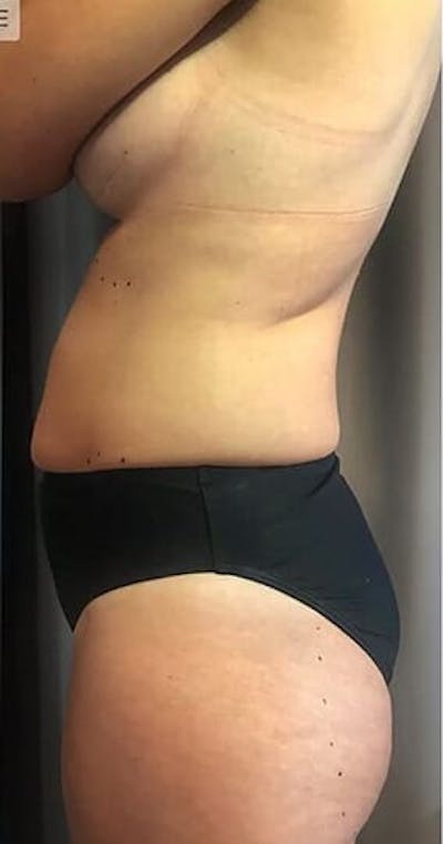 Body Contouring Before & After Gallery - Patient 801003 - Image 1