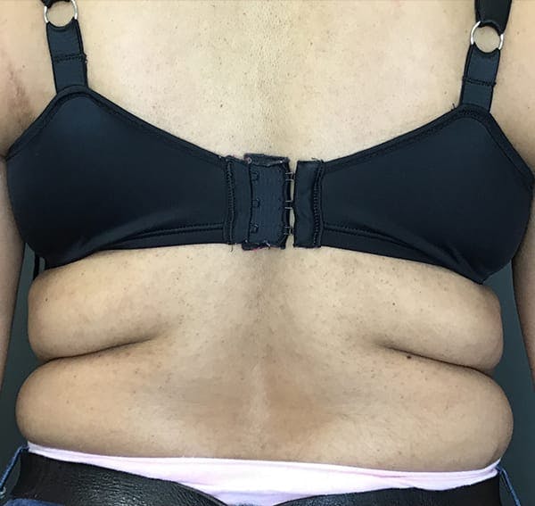 Body Contouring Before & After Gallery - Patient 270515 - Image 1