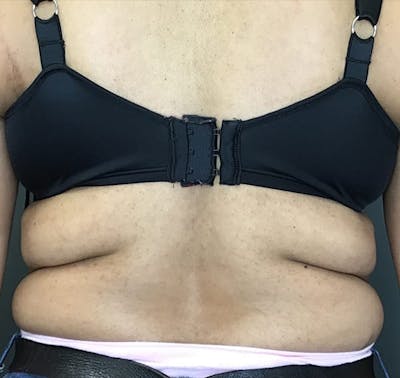 Body Contouring Before & After Gallery - Patient 270515 - Image 1