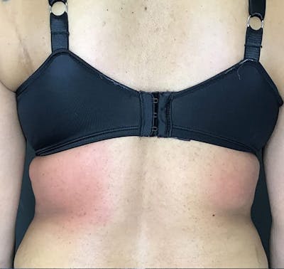 Body Contouring Before & After Gallery - Patient 270515 - Image 2