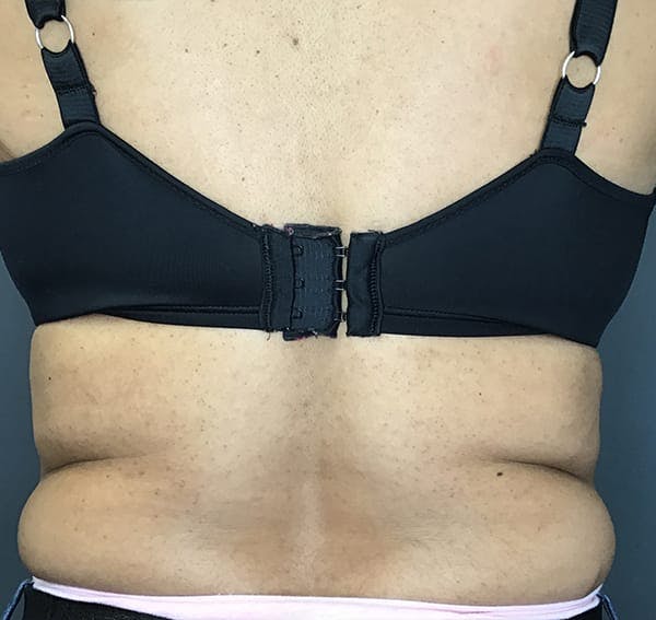 Body Contouring Before & After Gallery - Patient 270515 - Image 3