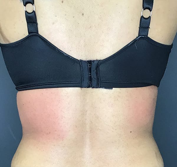 Body Contouring Before & After Gallery - Patient 270515 - Image 4