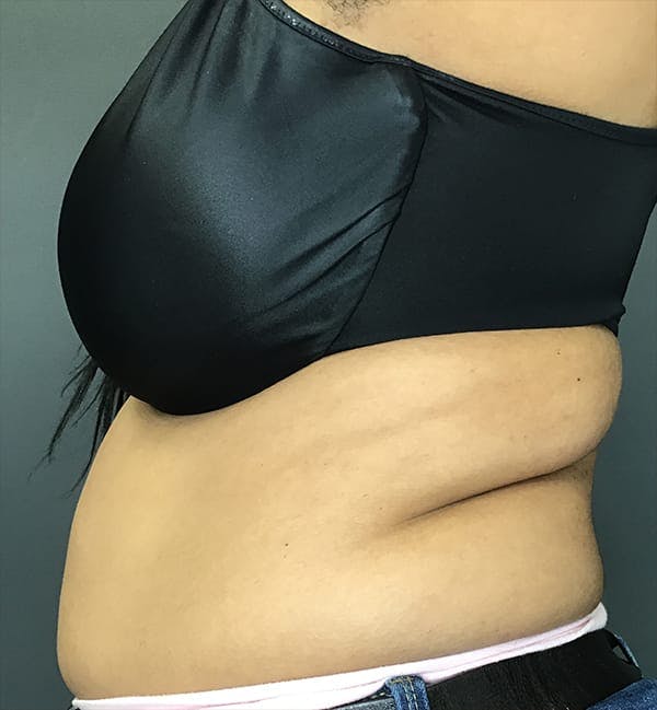 Body Contouring Before & After Gallery - Patient 270515 - Image 5