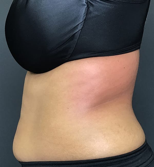 Body Contouring Before & After Gallery - Patient 270515 - Image 6