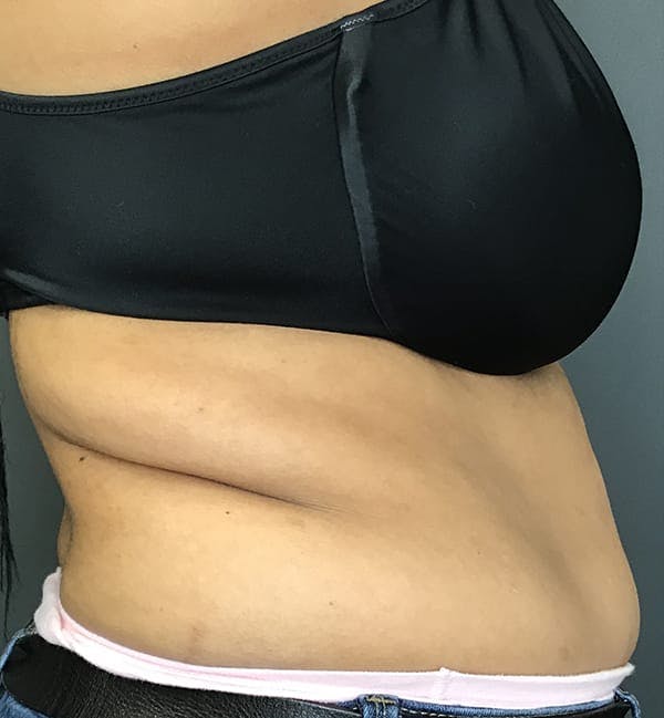 Body Contouring Before & After Gallery - Patient 270515 - Image 7