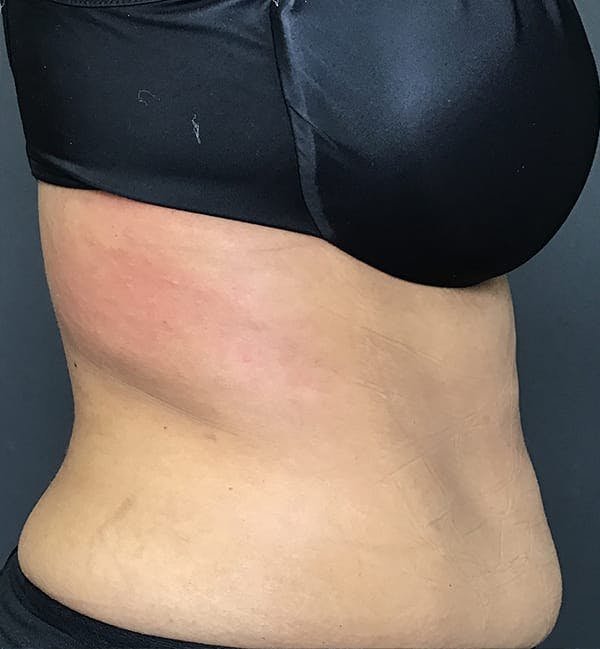 Body Contouring Before & After Gallery - Patient 270515 - Image 8