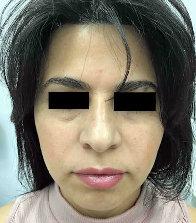 Facial Balancing Before & After Gallery - Patient 388392 - Image 1