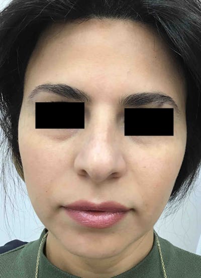 Facial Balancing Before & After Gallery - Patient 388392 - Image 2