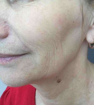 Laser Rejuvenation Before & After Gallery - Patient 409092 - Image 1